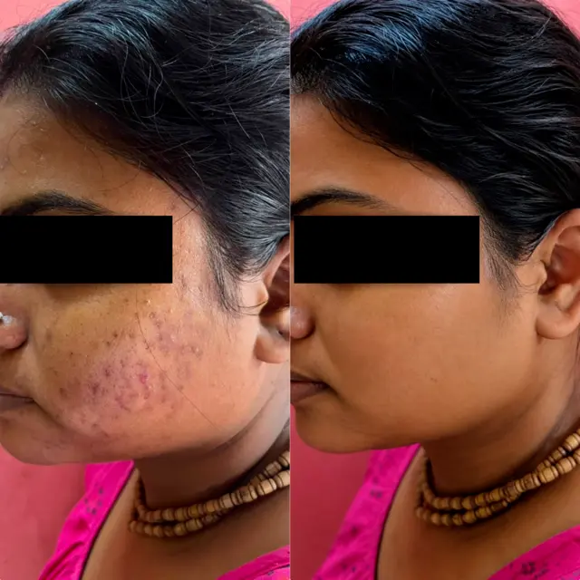 Client result at Sunshine Aesthetic Clinic
